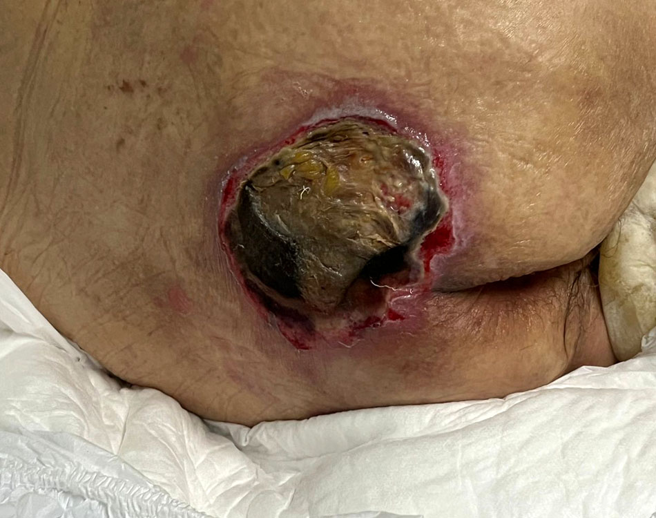 Wound Before Pulsar II™ Treatment