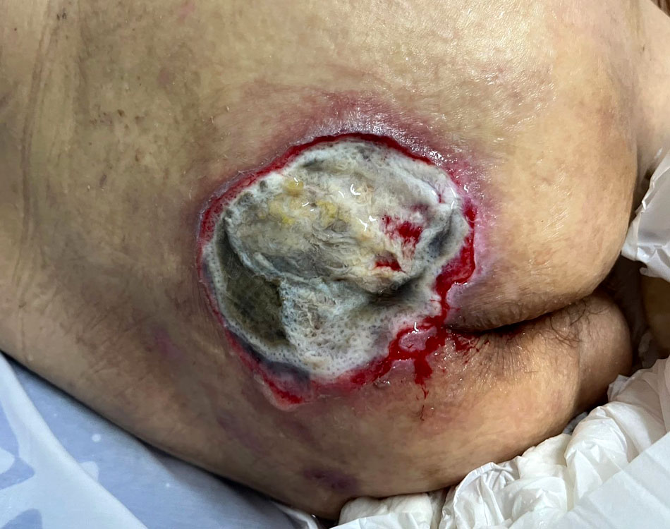 Wound After Pulsar II™ Treatment