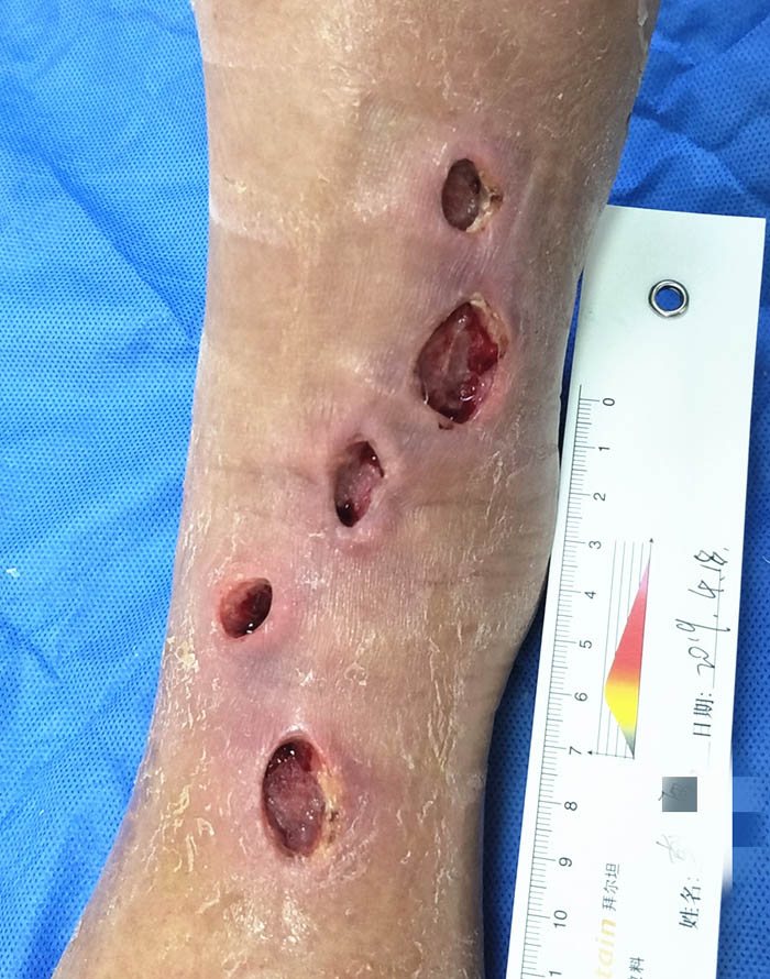 Ankle wound after treatment