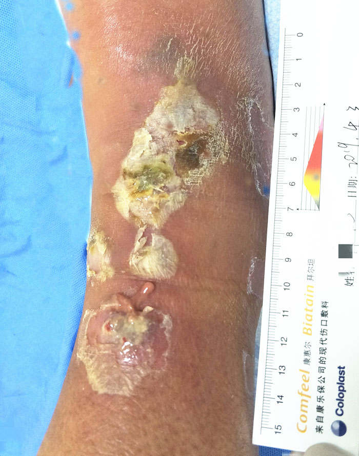 Ankle wound before treatment