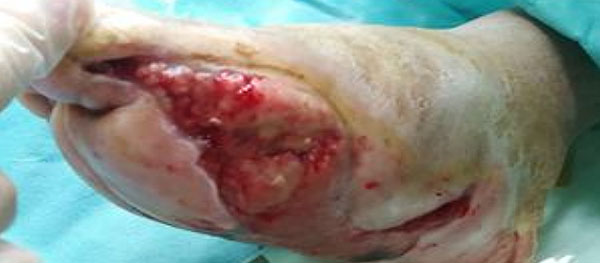 Epithelial crawling, wound size reduced