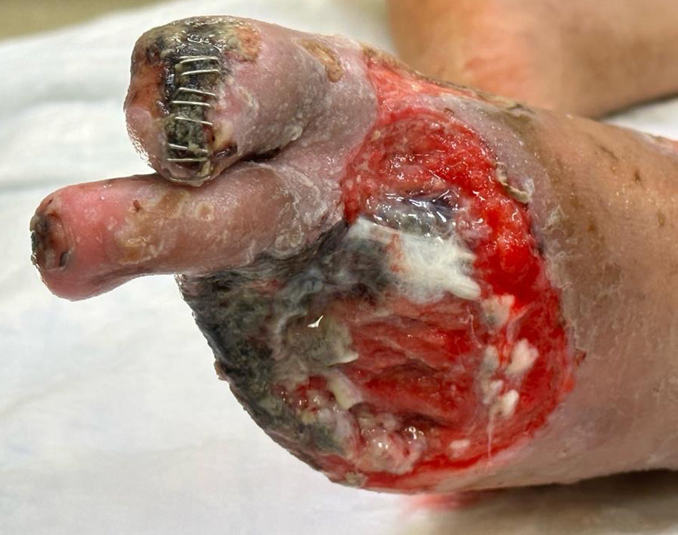 Foot Wound After Treatment