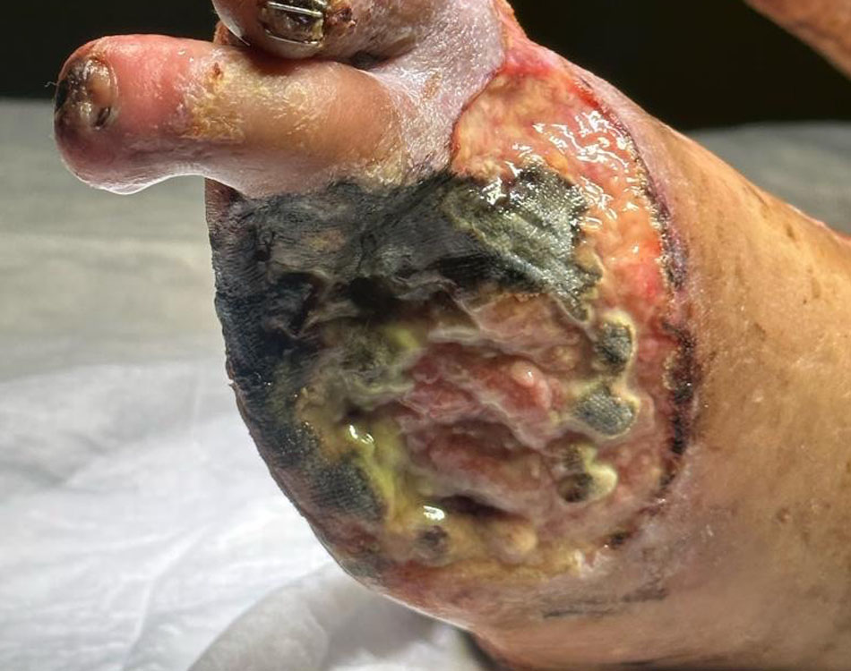 Foot Wound Before Treatment