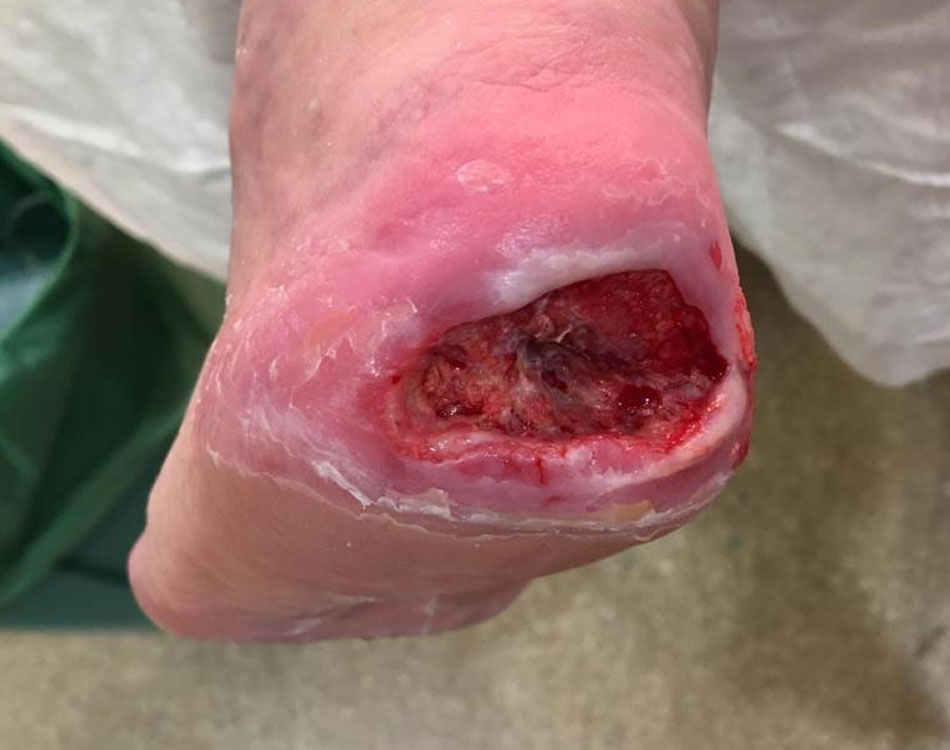 Foot Wound After Treatment