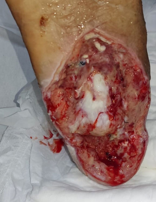 Foot Wound After Treatment