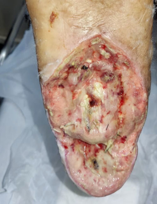 Foot Wound Before Treatment