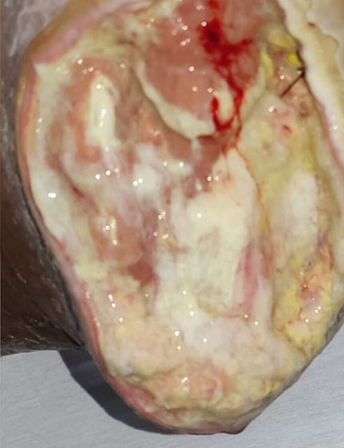 Foot Wound After Treatment