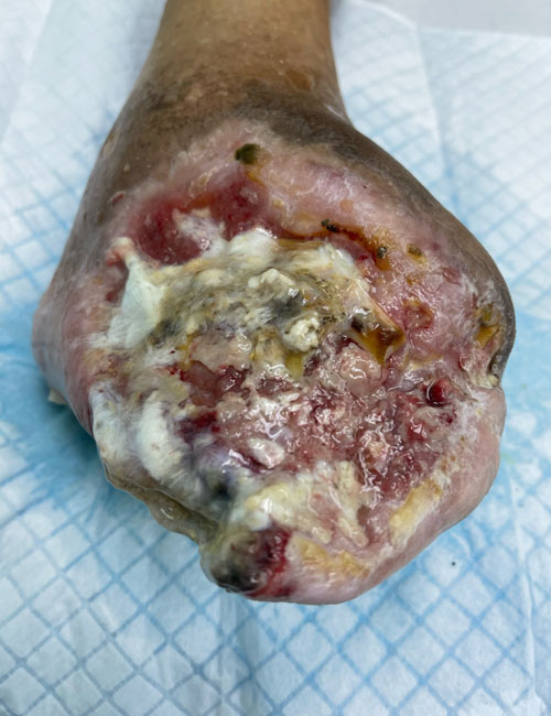 Foot Wound Before Treatment