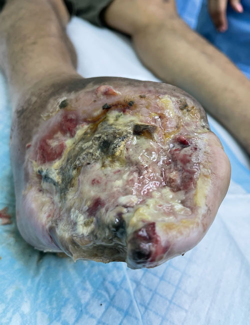 Foot Wound Before Treatment