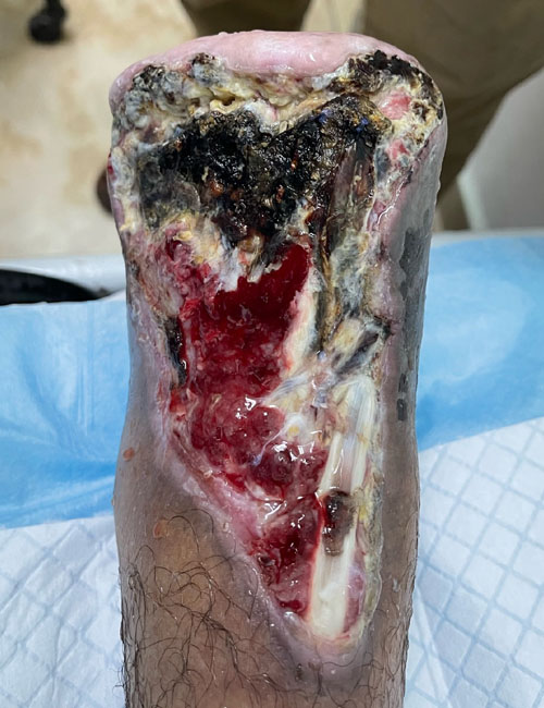 Food Wound After Treatment