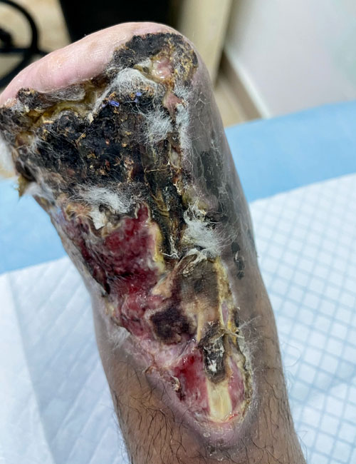 Foot Wound Before Treatment