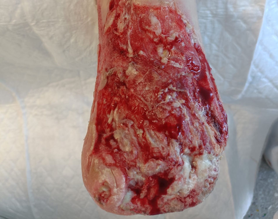 Foot Wound After Pulsar II™ Treatment