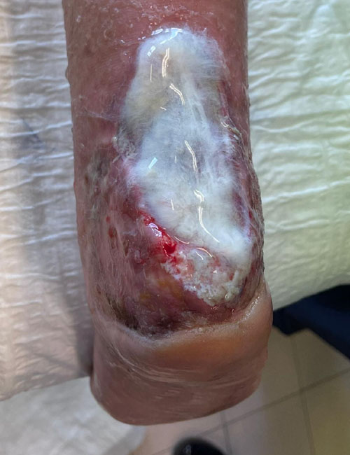 Leg Wound After Treatment