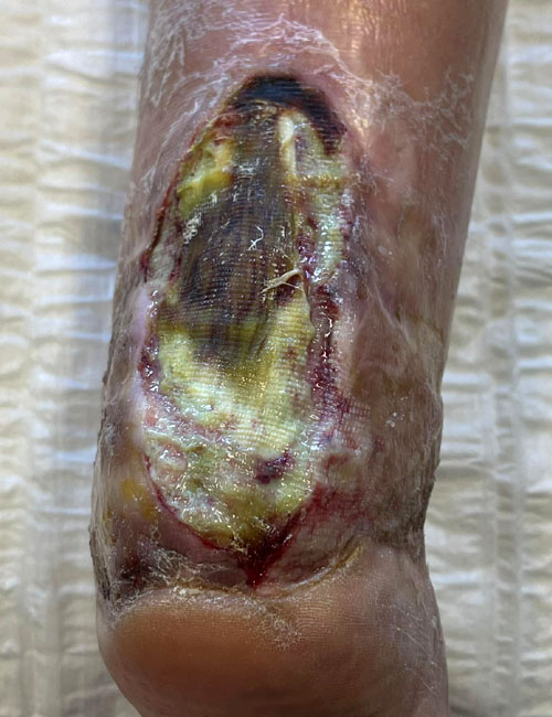 Leg Wound Before Treatment