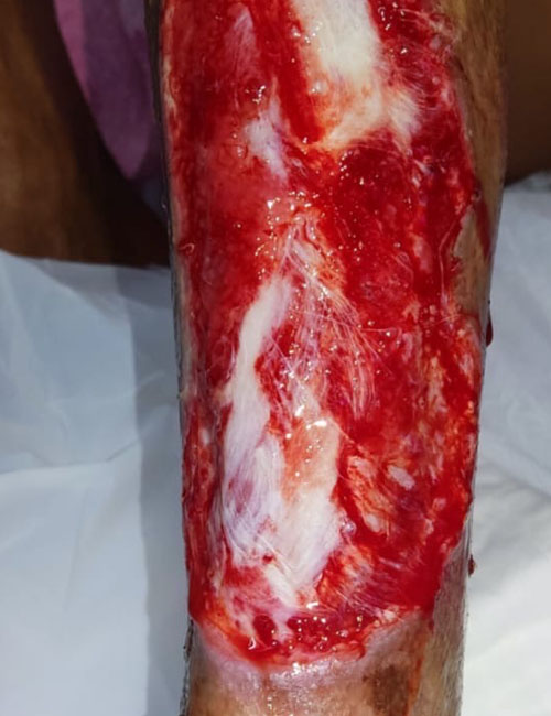 Leg Wound After Treatment