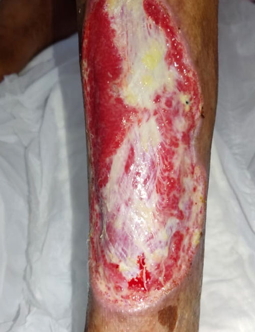 Leg Wound Before Treatment