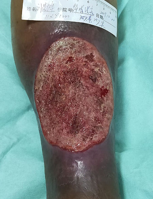 Leg Wound After Treatment