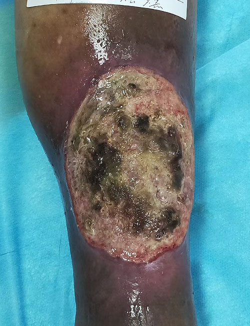 Leg Wound Before Treatment