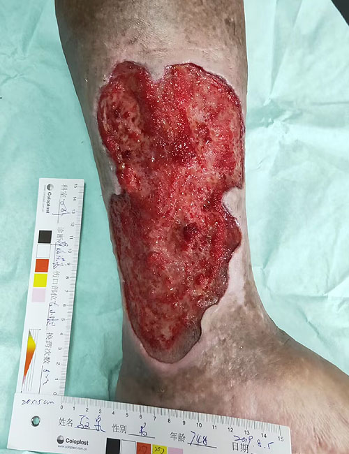 Leg Wound After Treatment