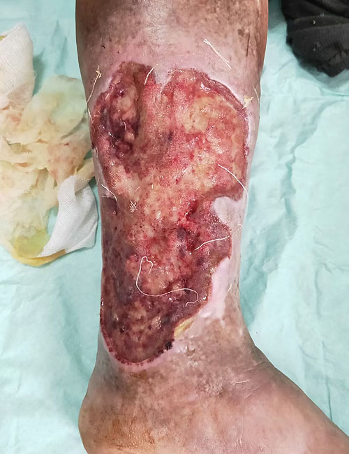 Leg Wound Before Treatment