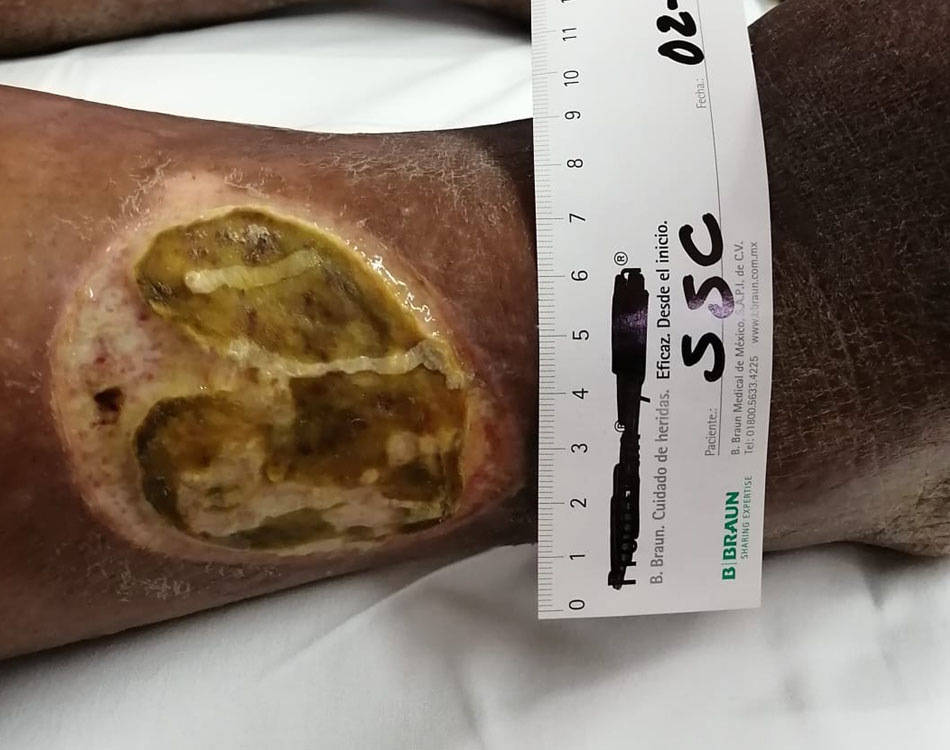 Leg Wound Before Treatment