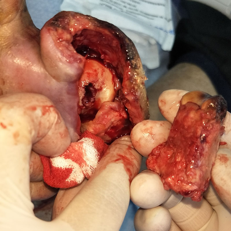 Toe after wound care treatment