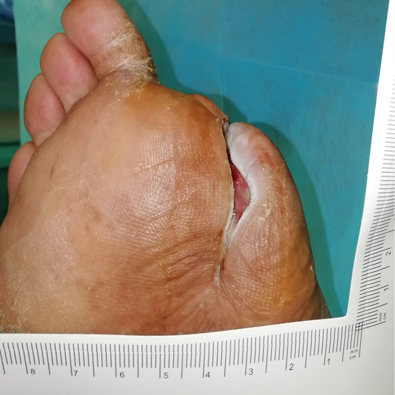 Toe when healed