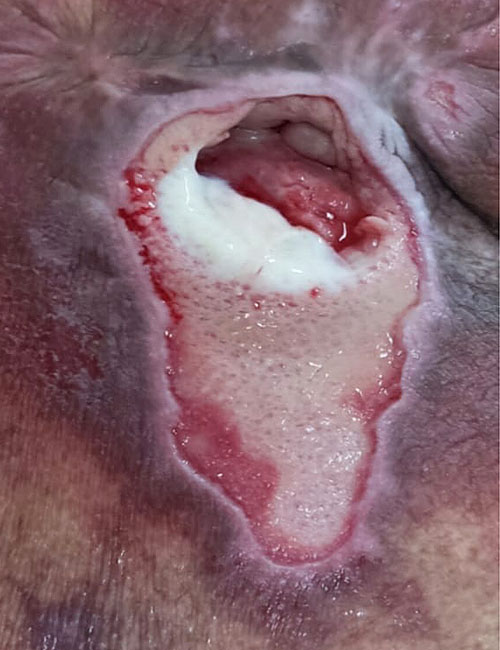 Wound After Treatment