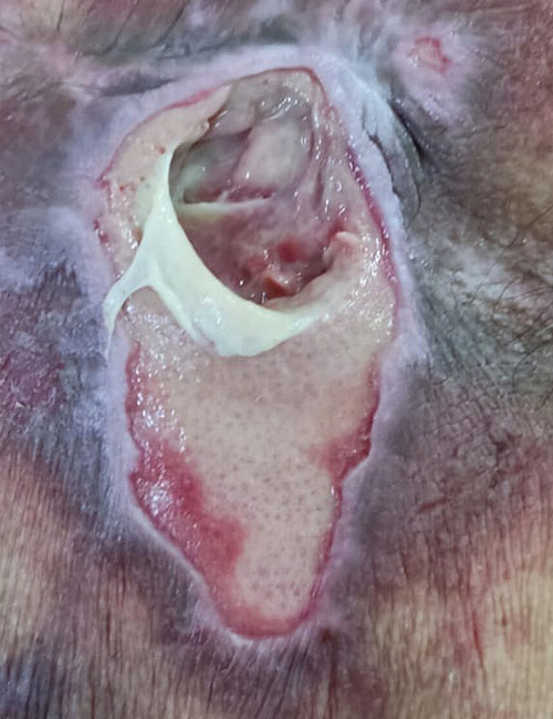 Wound Before Treatment