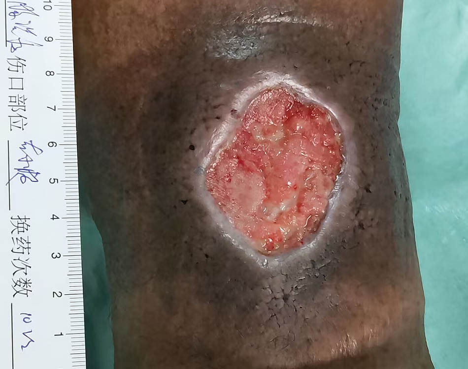 Wound After Treatment