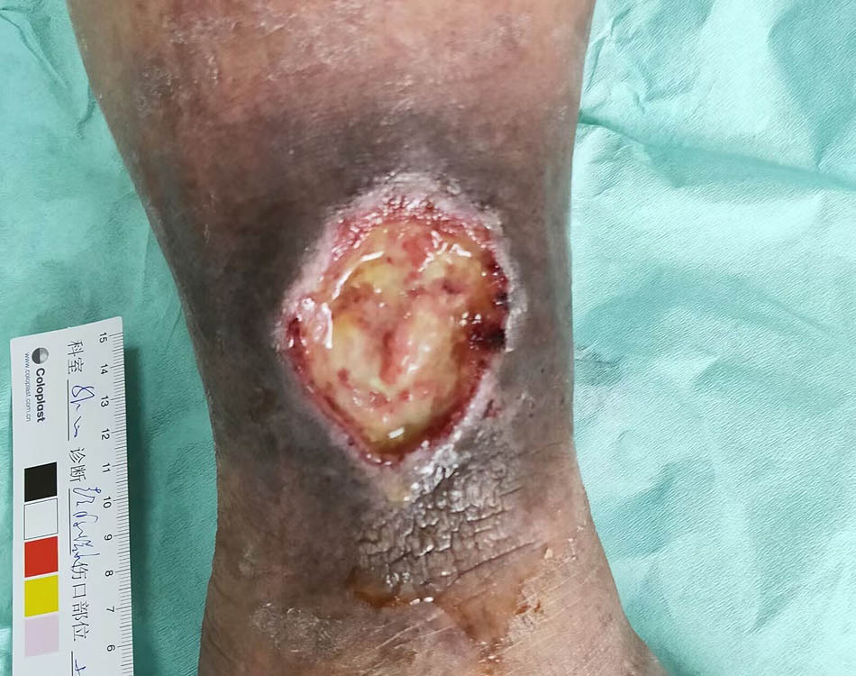 Wound Before Treatment